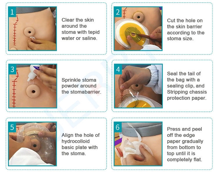 Two pieces disposable hydrocolloid ostomy bag