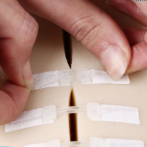 Medical surgical wound closure