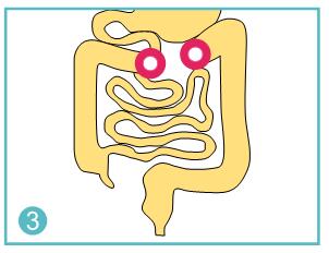 How many types of ostomy bag?