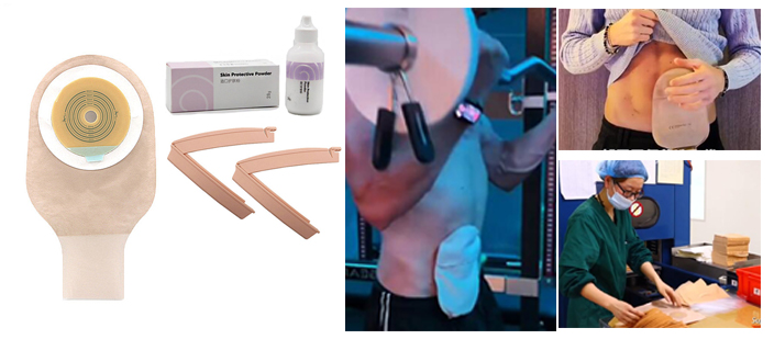 What is the function of ostomy bag should have? What is the function of ostomy bag should have?