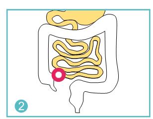 How many types of ostomy bag?