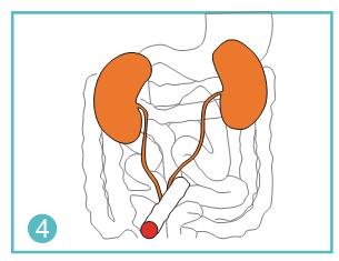 How many types of ostomy bag?